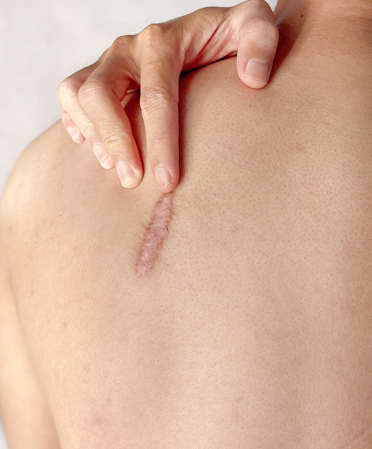 Hand touching a scar on bare skin.